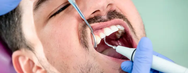 Plaque Removal and Scaling